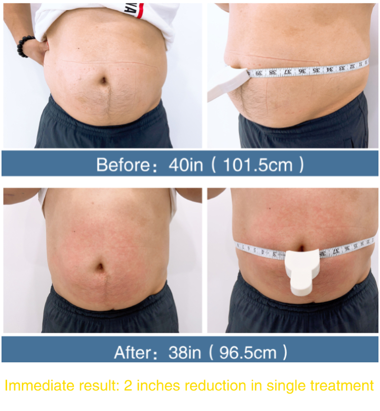 New technology 2022 radio frequency skin tightening Fat removing machine high power RF face lifting machine