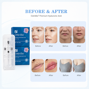 <span class=keywords><strong>Prix</strong></span> d'usine Ostin Bio Premium <span class=keywords><strong>Acide</strong></span> <span class=keywords><strong>Hyaluronique</strong></span> Injectable Remplisseur Dermique Logo Personnalisé Hydratation Profonde Soin du Visage Vente en Gros - Product Image 2