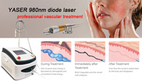 Vente directe d'usine traitement au laser classe IV 4 veine d'araignée efficace machine d'élimination vasculaire au laser à diode haute puissance
