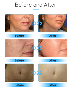 Nouvel appareil facial 2-en-1 à <span class=keywords><strong>radiofréquence</strong></span> pour le raffermissement cutané, avec micro-aiguilles RF fractionnées et marteau froid - Product Image 6