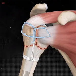 Uhmwpeファイバー縫合糸固定または調整可能なボタンデバイスエンドボタンSuturaUhmwpe縫合糸