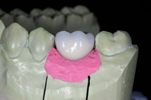 Tandheelkundige Zirkonia <span class=keywords><strong>Abutment</strong></span> En Tandheelkundige Schroefkronen Voor Tandheelkundig Implantaat - Product Image 6