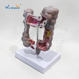 Modelo Patológico <span class=keywords><strong>de</strong></span> Intestino Grueso: Tuberculosis, Enfermedad <span class=keywords><strong>de</strong></span> Crohn, Colitis Ulcerativa, Inflamación - Product Image 6