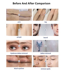 Épilation par <span class=keywords><strong>électrolyse</strong></span>, soin de la peau, épilation permanente, appareil d'épilation par <span class=keywords><strong>électrolyse</strong></span> avec aiguille pour le corps - Product Image 6