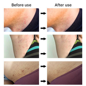 San fero — liquide de traitement pour la perte de cheveux, produit de rasage, traitement rapide en forme de goutte d'huile - Product Image 3