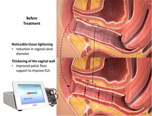 최소 침습적 휴대용 질 조임 980nm1470nm 다이오드 레이저 화장품 부인과 장치 - Product Image 3