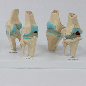 Modèle de genou articulé malade à 4 étapes - Le fabricant fournit des équipements pédagogiques médicaux - Product Image 2