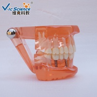 Restauration avec implant modèle de dents dentaires modèle d'enseignement des sciences médicales modèle de dents humaines