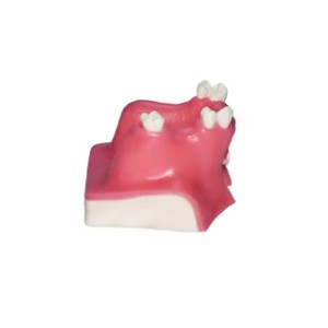 Modèle de communication médecin-patient pour l'implantation dentaire, aide pédagogique orale de classe I pour le lifting du sinus maxillaire, dents manquantes - Product Image 6