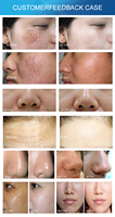 Pistolet de dermabrasion, exfoliant cutané, machine de thérapie par masque LED PDT, 3 poignées, 7 couleurs, UE/US, pour salon de beauté, peeling aquatique facial