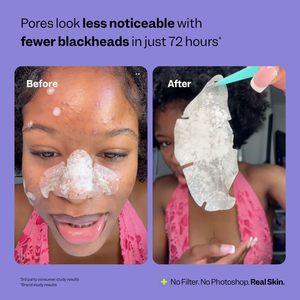 لاصقات مخصصة لإزالة الرؤوس السوداء والبثور من الأنف، تنظيف عميق للمسام وعلاج حب الشباب لجميع أنواع البشرة، مصدر OEM - Product Image 2