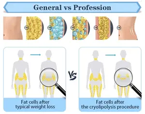 S23 5 kolları Cryo ve soğuk lipoliz cihazı çok fonksiyonlu zayıflama 360 Criolipolisis makinesi kilo kaybı vücut zayıflama/yağ donma