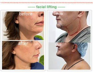 2025 Mais Novo 1470nm Diodo <span class=keywords><strong>Laser</strong></span> Fibra Médica Lipólise Lipoaspiração Dispositivo Endolaser Levantamento Facial - Product Image 5