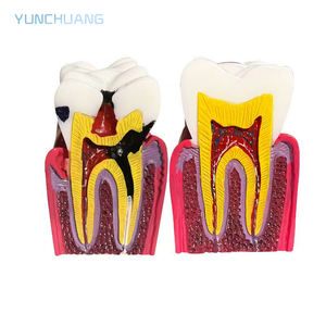 แบบจำลองการสอนทางทันตกรรมสำหรับชิ้นส่วนฟันผุ; แบบจำลองการสอนทางทันตกรรมสำหรับการสาธิต; แบบจำลองการเปรียบเทียบฟันผุ 6 เท่า - Product Image 6