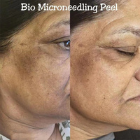 ZS efficace Spongilla Spicules Biomicroneedling algues Peeling poudre d'éponge hydrolysée pour l'acné Melasma Hyperpigmentation