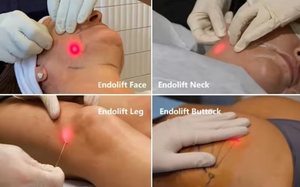 360 Lipo Lab Fat Dissolving Injections Laser Endoskin Endolaser 980nm 1470nm Liposuccion <span class=keywords><strong>Lipolyse</strong></span> <span class=keywords><strong>Double</strong></span> Chin Removal Device - Product Image 3