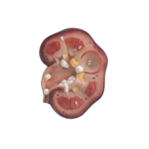 Modèle pédagogique de calcul rénal pour l'enseignement en urologie - Product Image 3