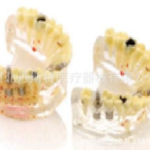 Modèle d'implant dentaire Dt M2007, modèle d'enseignement en silicone médical, anatomique, pour les sciences médicales - Product Image 1