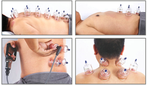 Professionelles 19-teiliges Schröpftherapie-Set zur Myofaszialen Entspannung, Hijama-Werkzeug mit Pumpe für Sichere Anwendung als Körper-Schröpfgläser - Product Image 6