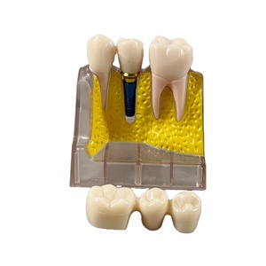 Mô hình cấy ghép răng 4 lần cho khoa học y tế - Product Image 3