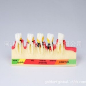 Modèle d'enseignement dentaire Dt M4010 en silicone médical, classification parodontale anatomique 5.8x2.8x4.8 pour la science médicale - Product Image 1