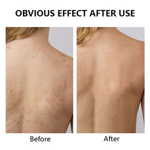 Cerotti Idrocolloidali Autoadesivi Ultra Assorbenti OEM ODM, Flessibili e Impermeabili, Ritagliabili, per Acne su Viso e Corpo - Product Image 5