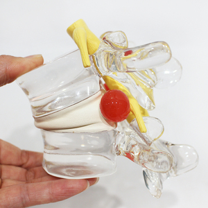 Modèle anatomique comparatif de hernie discale lombaire en PVC pour la formation en orthopédie et en laboratoire d'anatomie CE/ISO/ROHS/CNAS - Product Image 1