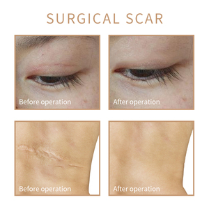 Kit de Micropigmentación Semipermanente para Camuflaje de Estrías y Vitiligo de Marca Privada - Product Image 6