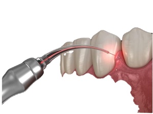 เส้นใยควอตซ์ DIA 600 UM 304อ่อนท่อสแตนเลสความยาว25มมใยแก้วนำแสงทันตกรรม - Product Image 5