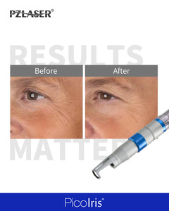 Machine laser Picoseconde Picolris <span class=keywords><strong>pour</strong></span> clinique – Énergie verticale accrue <span class=keywords><strong>pour</strong></span> l'élimination des tatouages <span class=keywords><strong>noirs</strong></span> et colorés - Product Image 4