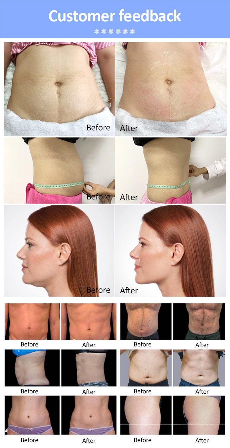 Cryo Fit Weight Loss Vacuum Therapy Slimming Body Machine Anti Cellulite Machine Fat Cold Therapy Cellulite Removal Machine