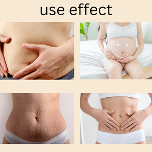 <span class=keywords><strong>ครีม</strong></span>ลบ<span class=keywords><strong>รอย</strong></span>แผลเป็นจาก<span class=keywords><strong>สิว</strong></span>,<span class=keywords><strong>ครีม</strong></span>รักษาแผลเป็นยืดได้ตามต้องการ - Product Image 4