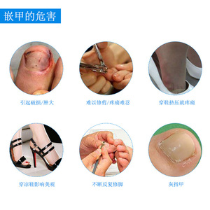 10 patchs pour ongles incarnés, pour corriger les larges sillons des ongles et l'inflammation des ongles. - Product Image 1
