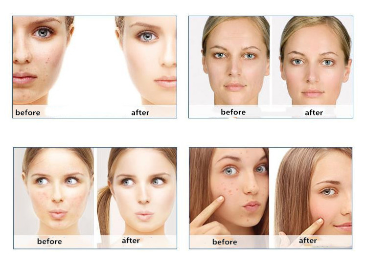 First generation 6 In 1 facials Machine Small Bubble Skin Treatment Machines for Scar Acne Removal