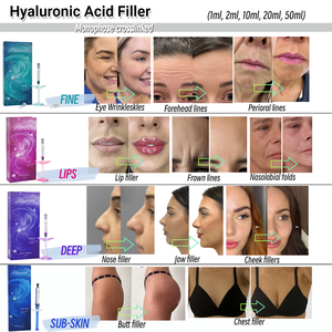 Subskin 26mg ml 10ml <span class=keywords><strong>Acide</strong></span> <span class=keywords><strong>Hyaluronique</strong></span> Injectable pour Remplissage Corporel, Augmentation des Fesses, Remodelage Corporel, Gel Dermal Réticulé - Product Image 6