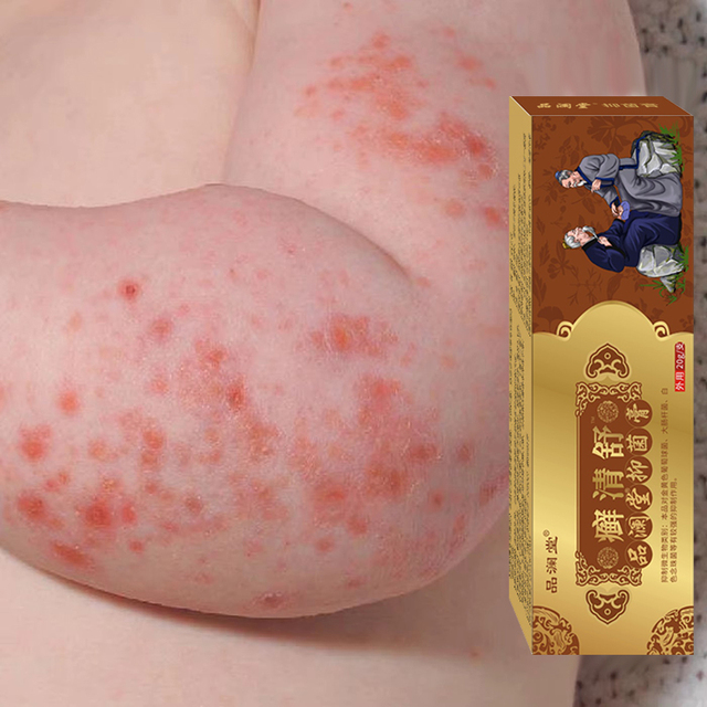 Wholesale Custom Herbal Skin Care Cream Skin Eczema Ointment Cooling and Comforting Soothe Skin Discomfort