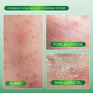 KORMESIC – Kit de Soins Anti-Acné et Éclaircissant en Gros : Nettoyant Visage, Gel Réparateur, Essence et Eau pour une Peau Nette et Lumineuse - Product Image 3