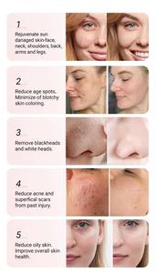 Direct Sale Oxygen Jet Diamond Microdermabrasion Skin Deep Cleaning Skin Rejuvenation Super Bubble Hydroo Aqua Facial - Product Image 6