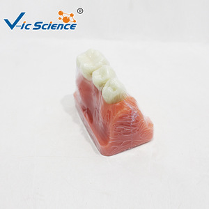 Modèle d'implant triple couronne en argent ; modèle de démonstration de communication dentaire médecin-patient - Product Image 4