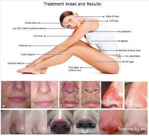 Máquina láser para eliminación de venas vasculares/spider, 980 nm, tratamiento de rosas - Product Image 3