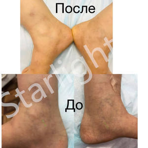 Máquina de Láser de Diodo Profesional de 980nm <span class=keywords><strong>para</strong></span> <span class=keywords><strong>Tratamiento</strong></span> Facial/de Piernas, Venas Varicosas y Arañas Vasculares - Product Image 4