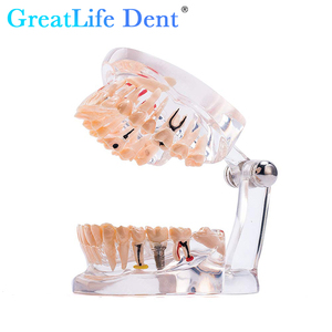 Modelo de Estudio de Patología Dental Greatlife Dent XVD2530 con Certificación CE Clase I, Implante Dental de 32 Dientes, Diseño Transparente - Product Image 1