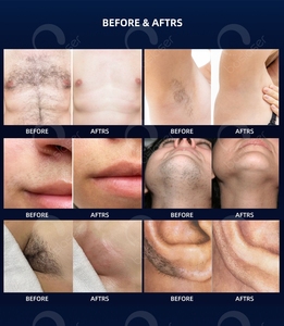 Appareil professionnel d'épilation au laser, équipement pour les traitements esthétiques, rajeunissement de la peau, appareil compact d'épilation au laser - Product Image 6