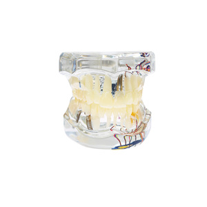 Modelo patológico hemisférico transparente, modelo dental patológico completo, modelo dental desmontable, implante - Product Image 1