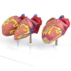 Modèle <span class=keywords><strong>de</strong></span> comparaison du cœur humain sain <span class=keywords><strong>et</strong></span> malade en 3 pièces, modèle d'enseignement <span class=keywords><strong>de</strong></span> l'anatomie des lésions cardiaques pour l'éducation en classe <span class=keywords><strong>de</strong></span> biologie - Product Image 3