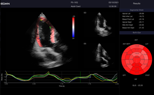 Appareil d'échographie Doppler couleur sur chariot Edan LX9 avec 5 ports de transducteurs actifs pour l'échographie diagnostique humaine - Product Image 6