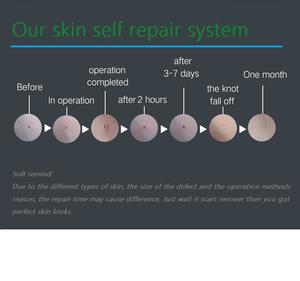 ปากกาพลาสมาไฟโบรบลาสต์ กำจัดไฝ กระ จุดด่างดำ รอยสัก หูด กำจัดรอยแผลเป็น ขายดี - Product Image 4