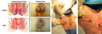 Appareil laser à double longueur d'onde 980 nm 1470 nm pour proctologie, hémorroïdes, fissures, fistules, sinus pilonidien, PLDD, ENLT, élimination vasculaire