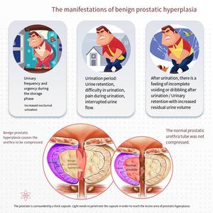 पेरिनम और निचले पेट में ऊतक की मरम्मत को बढ़ावा देना। लाल प्रकाश 640nm लेजर प्रोस्टेट मालिश दर्द से राहत देता है - Product Image 3