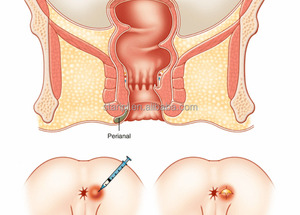 Dispositivo de Tratamiento de Hemorroides 1470nm 980, Cirugía Médica, Proctología, Fístula Anal, Hemorroides, Corte, Uso en Clínica y Hospital - Product Image 6